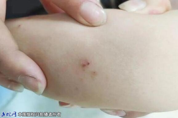 恩泽六岁孩子被毒蛇咬伤、家人急送医院...