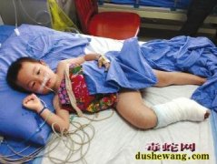 宜宾一幼童被毒蛇咬伤 找“土医生”致...