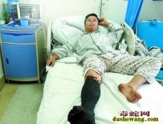 男子回老家被毒蛇咬伤花费上万 母亲想...