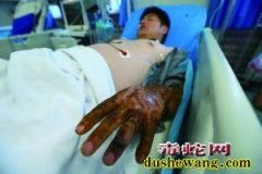 工人夜宿工地遭毒蛇咬伤 无生命危险或...