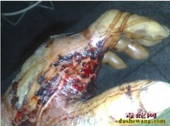 被五步蛇咬了怎么办