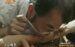 毒蛇咬伤的处理