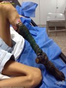 恐怖慎入！遭毒蛇咬后女孩的腿萎缩变黑...