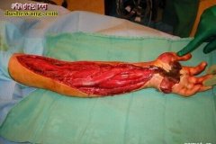 毒蛇胶伤 毒蛇咬死人有多少