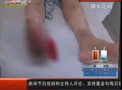 广东肇庆一老人被毒蛇咬伤，为保命断右...