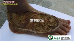 中医治疗毒蛇咬伤“辩证治疗”是什么