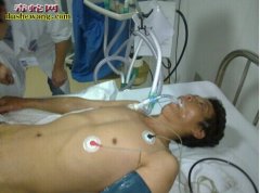 雷村蛇场学员68期眼镜王蛇咬伤案例