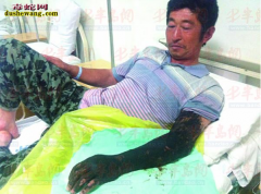 蛇咬伤的急救与护理