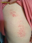蛇缠腰初期图片