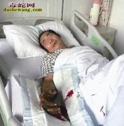 除草被竹叶青蛇咬伤 175医院一夜收...