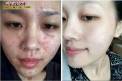 蛇油祛痘 蛇油有祛痘的功效吗？