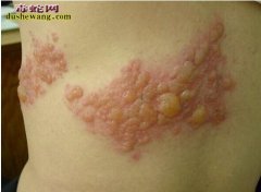 蛇胆疱疹 蛇胆疱疹是什么？怎么治疗？