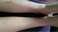 【皮肤干燥像蛇皮】