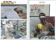 银环蛇咬伤：秀山55岁男子被银环蛇咬...