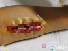9岁男孩把毒蛇当绳子玩被咬伤！左臂变...