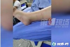 深圳小区怀胎7月孕妇被毒蛇咬伤！竹叶...
