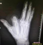 又一毒蛇咬伤断指保命！杭州男子被五步...