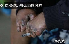 乌梢蛇治身体顽麻风方