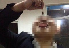 蛇胆能生吃吗？生吃了蛇胆怎么办？