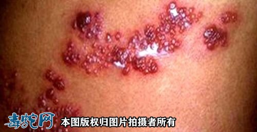 长了蛇蛋疮能吃什么不能吃什么？