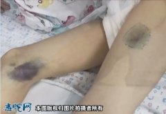 广西9岁小男孩被毒蛇咬伤住进ICU！...