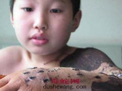 被圆斑蝰蛇咬伤的症状及诊断