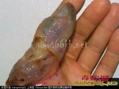 毒蛇咬伤的诊断和鉴别方法